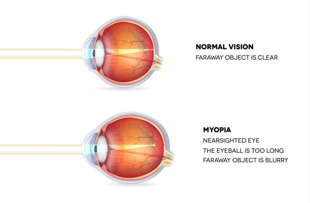 An illustrated diagram of two eyes, one with normal vision and one with myopia.